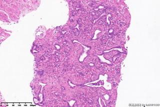 前列腺穿刺组织图23