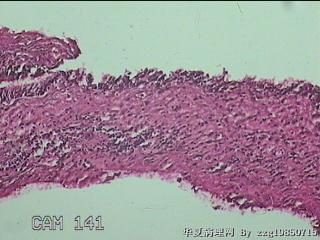 鼻窦新生物图18