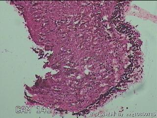 鼻窦新生物图16