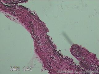 鼻窦新生物图20