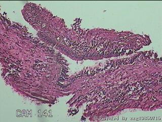 鼻窦新生物图19