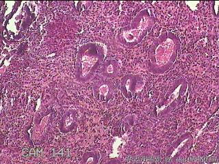 子宫内膜息肉图38