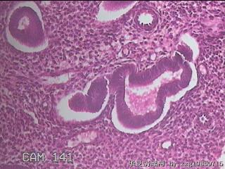 子宫内膜息肉图43