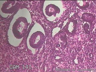 子宫内膜息肉图46