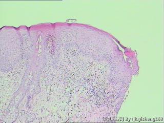 外阴白斑活检--慢性单纯性苔藓？还是扁平苔藓图2
