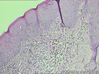 外阴白斑活检--慢性单纯性苔藓？还是扁平苔藓图6