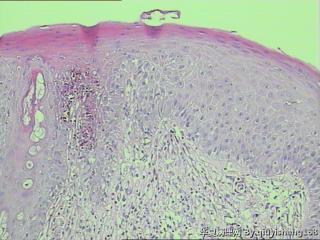 外阴白斑活检--慢性单纯性苔藓？还是扁平苔藓图3
