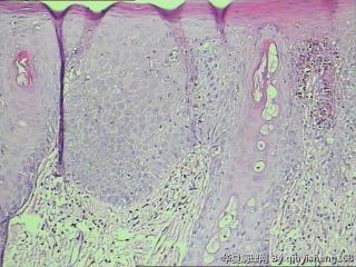 外阴白斑活检--慢性单纯性苔藓？还是扁平苔藓图5