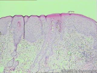 外阴白斑活检--慢性单纯性苔藓？还是扁平苔藓图1