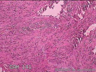 子宫颈粘膜下肌瘤图41