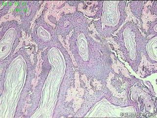 额部肿物，脂溢性角化病？请教！图1