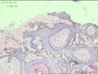 额部肿物，脂溢性角化病？请教！图4