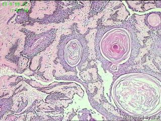 额部肿物，脂溢性角化病？请教！图2