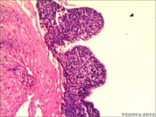 男，69岁，食道粘膜活检图17