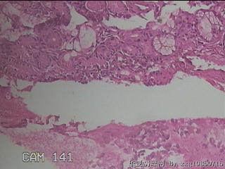 双侧鼻腔新生物图37