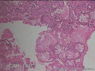 双侧鼻腔新生物图47