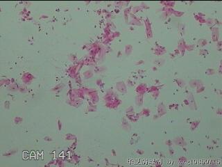 宫颈HPV16阳性图2