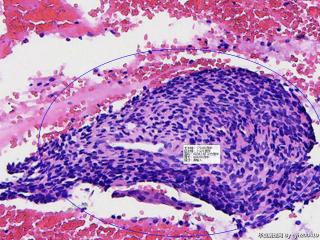 一块是子宫内膜间质（图1），另一块确定不是鳞癌吗（图2）？同一病人图2