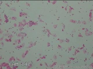 宫颈HPV16阳性图41