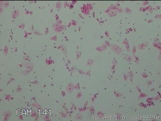 宫颈HPV16阳性图42