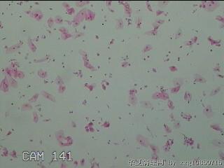 宫颈HPV16阳性图45