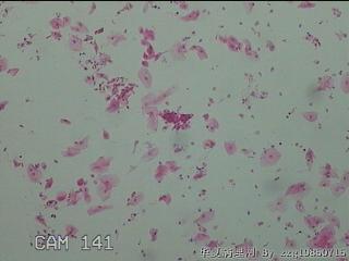 宫颈HPV16阳性图11