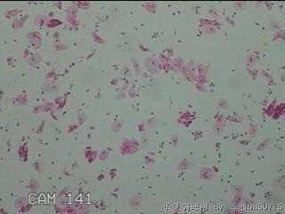 宫颈HPV16阳性图43