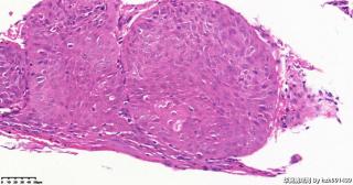 鳞癌？图18