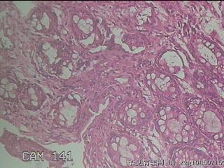 直乙结肠粘膜图14