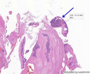 宫颈管组织，请帮看看这些区域是鳞化还是瘤变？图1