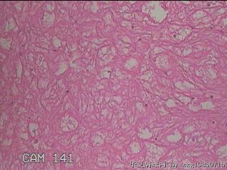 双侧鼻腔新生物图31