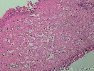 双侧鼻腔新生物图16