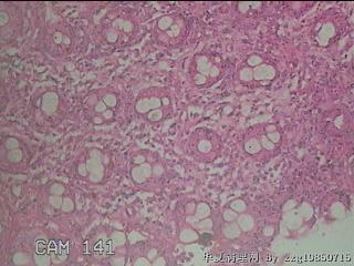 直乙结肠粘膜图26