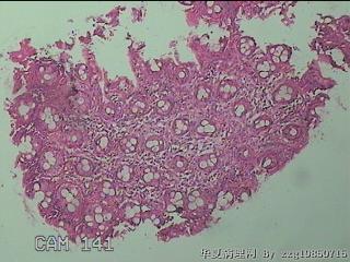 直乙结肠粘膜图14