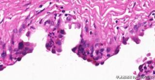肺大疱，是发肺泡源性肺囊肿吗？图4