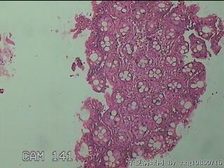直乙结肠粘膜图13