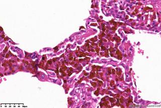 肺大疱周围组织，这些是含铁血黄素细胞吗？图12