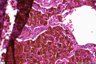 肺大疱周围组织，这些是含铁血黄素细胞吗？图13