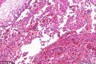 肺大疱周围组织，这些是含铁血黄素细胞吗？图7