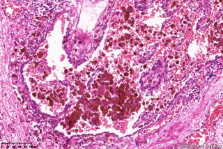 肺大疱周围组织，这些是含铁血黄素细胞吗？图3