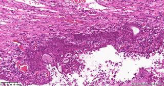 宫颈,HPV52(+),请教这些区域是CIN还是鳞化？图9