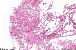 肺大疱周围组织，这些是含铁血黄素细胞吗？图2