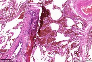 肺大疱周围组织，这些是含铁血黄素细胞吗？图11