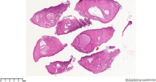 宫颈,HPV52(+),请教这些区域是CIN还是鳞化？图1