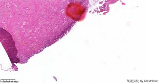 宫颈,HPV52(+),请教这些区域是CIN还是鳞化？图6