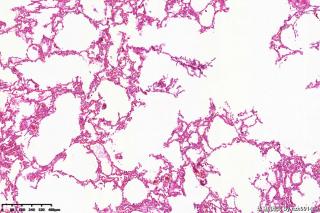 肺大疱组织图17