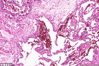 肺大疱周围组织，这些是含铁血黄素细胞吗？图4