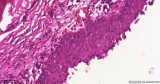 宫颈,HPV52(+),请教这些区域是CIN还是鳞化？图4