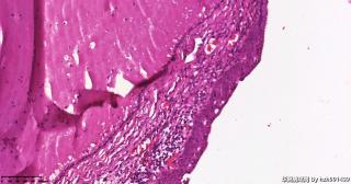 宫颈,HPV52(+),请教这些区域是CIN还是鳞化？图5