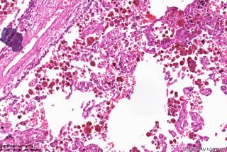 肺大疱周围组织，这些是含铁血黄素细胞吗？图8